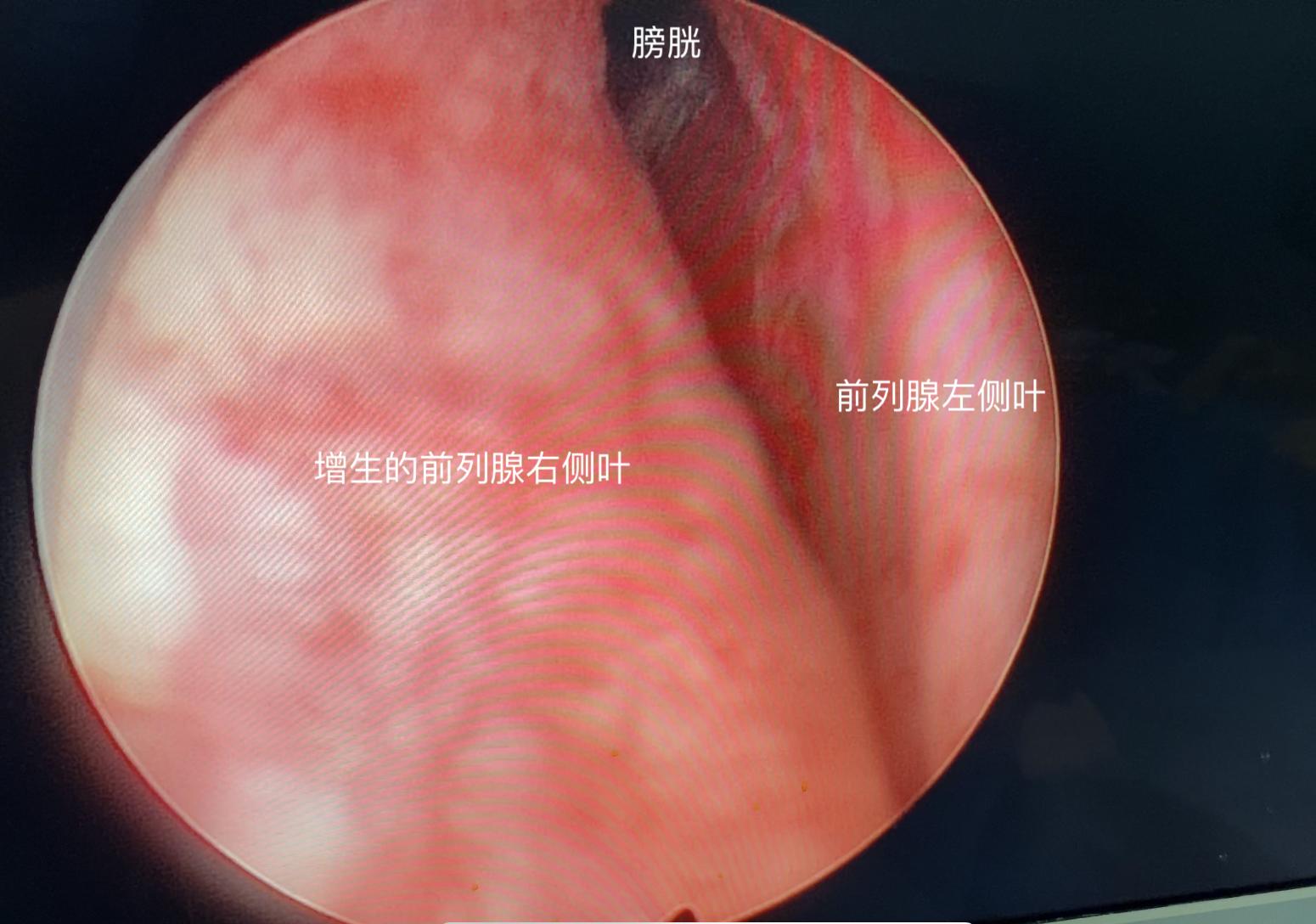 如何判斷自己是否患有前列腺炎，癥狀、診斷與預(yù)防，前列腺炎的癥狀、診斷與預(yù)防措施詳解，如何判斷自身狀況？