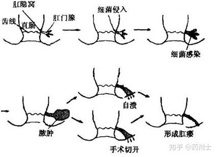 陽瘺會自己恢復(fù)嗎？——深入了解與應(yīng)對方法，陽瘺會自己恢復(fù)嗎？探究自然恢復(fù)方法與應(yīng)對之道