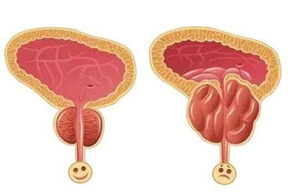 男性前列腺增大是什么原因引起的，男性前列腺增大原因解析，多種因素導(dǎo)致前列腺增大