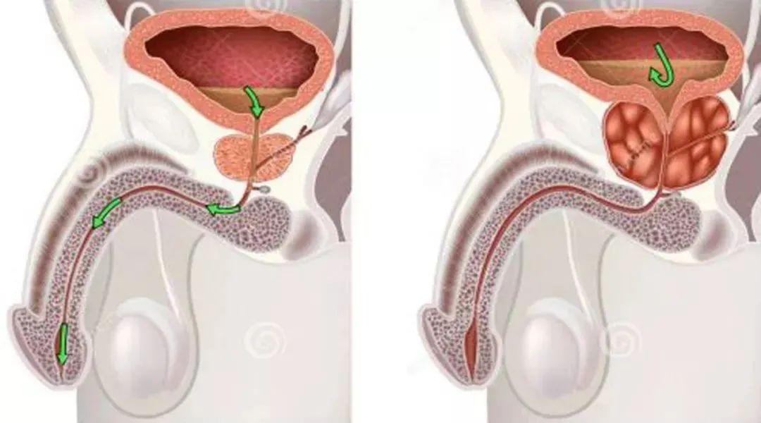 前列腺腺管疏通，費(fèi)用與價(jià)值的重要性，前列腺腺管疏通，費(fèi)用與治療效果的價(jià)值考量