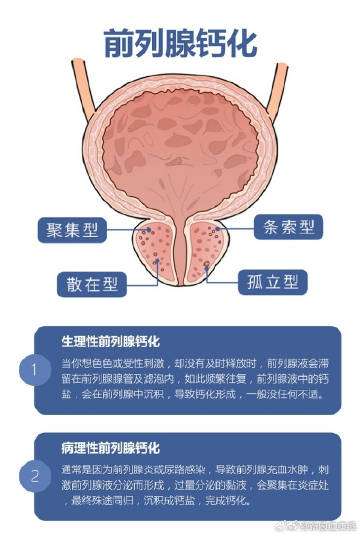 年輕人28歲前列腺鈣化，了解、預防與管理，年輕人前列腺鈣化，了解、預防與管理全攻略